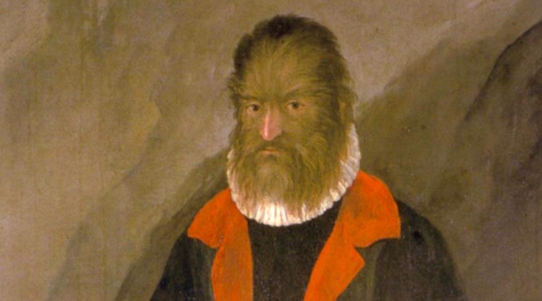 Kurt Adam Efsanesi Gerçek Bir Hastalıktan mı Çıktı?